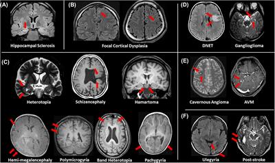 Making the Invisible Visible: Advanced Neuroimaging Techniques in Focal Epilepsy